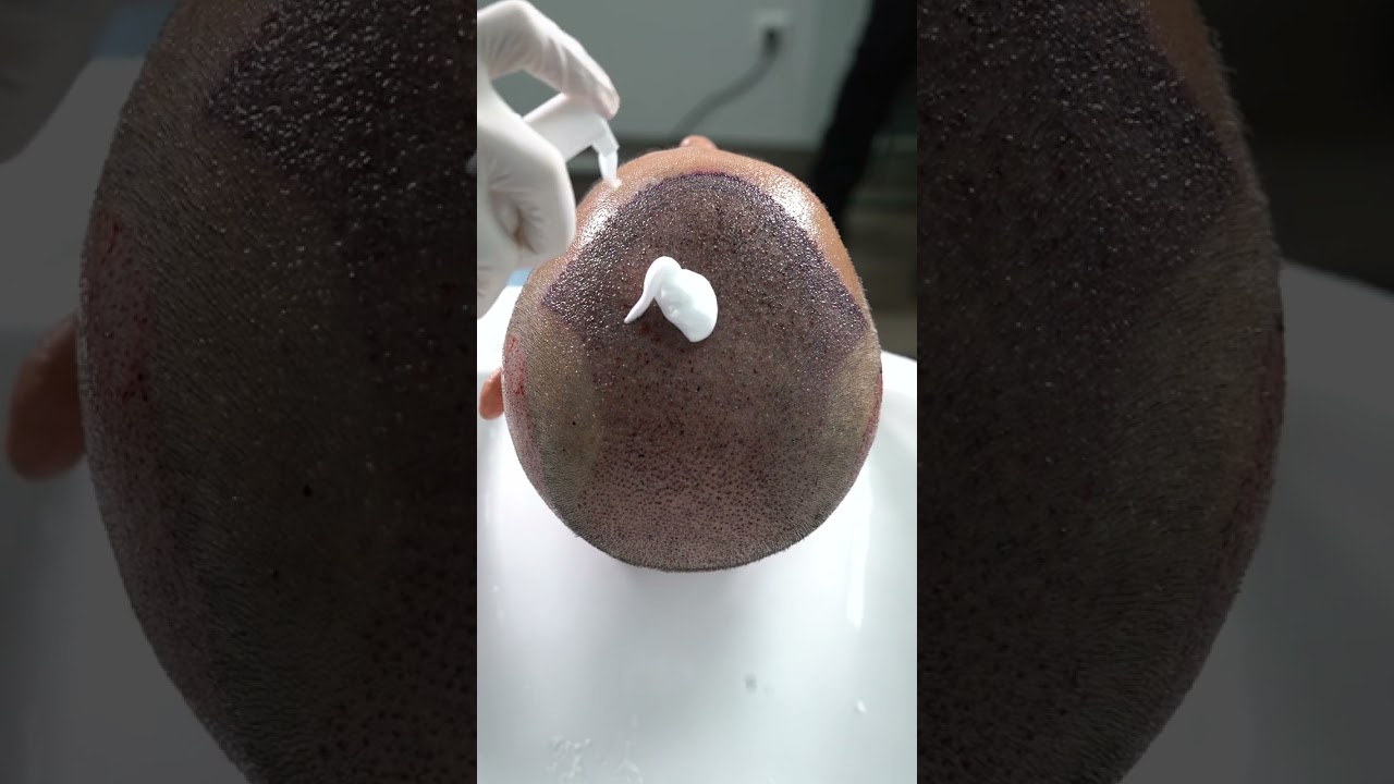 First Hair Wash After the Hair Transplant || Long Hair Center Istanbul.