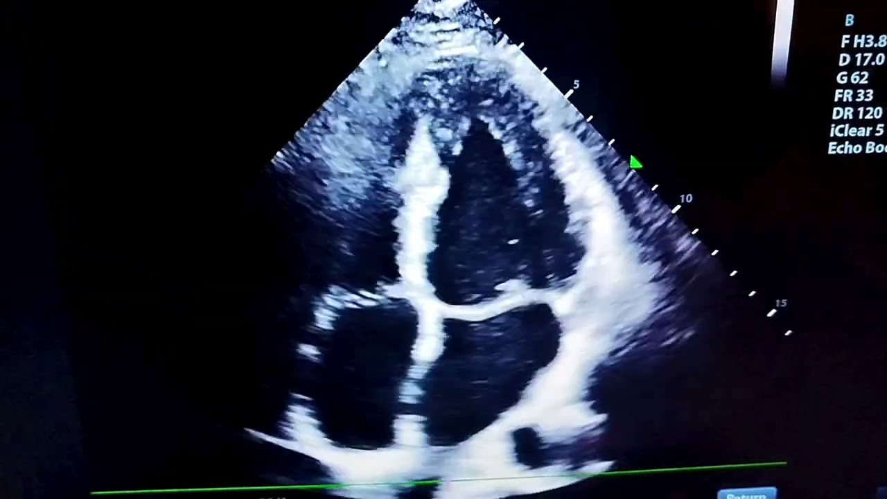 What do you think about Segmental wall motion abnormalities?