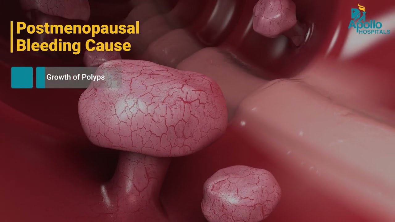 Saignements post-m&eacute;nopause: Quand consulter et traitements | Dr. Revathi | Apollo Secunderabad