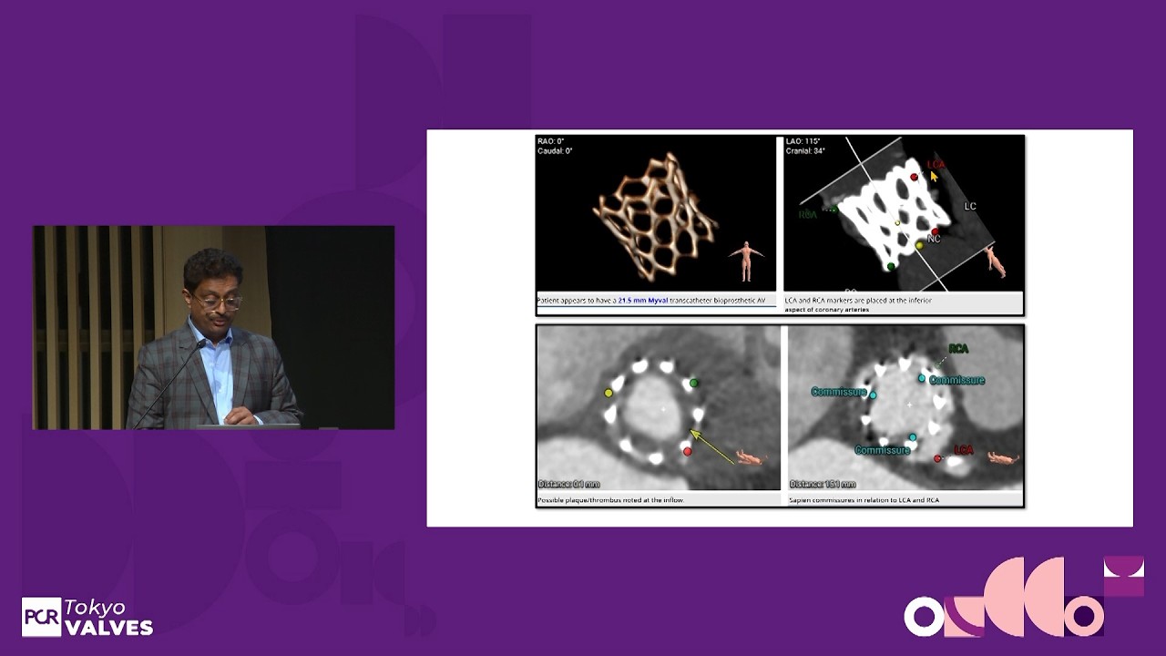 Design that delivers the future of TAVI - PCR Tokyo Valves 2025