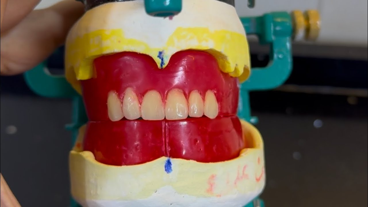 Arrangement/Setting of upper Anterior teeth
