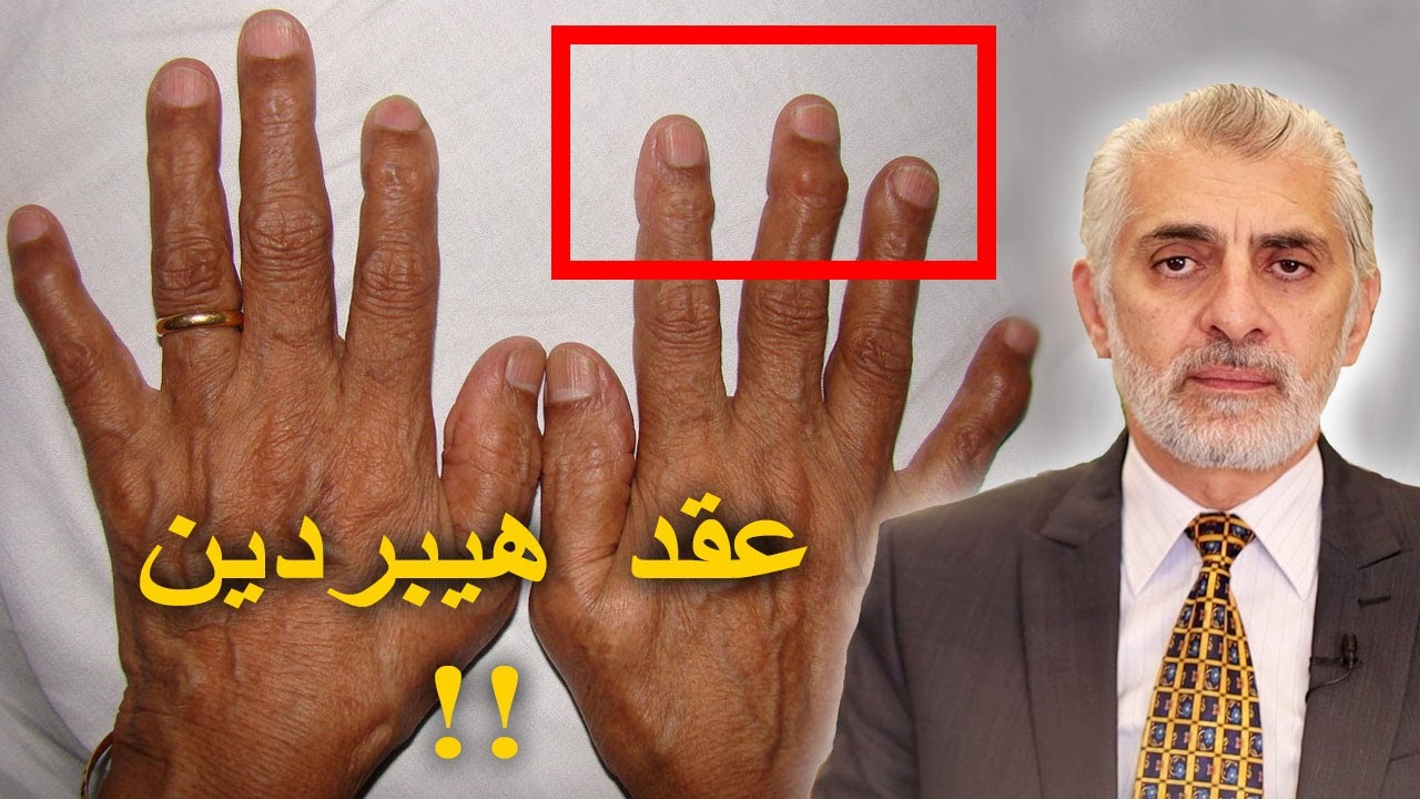 عقد هيبيردن - بروزعظام مفاصل الأصابع - Heberden Nodes