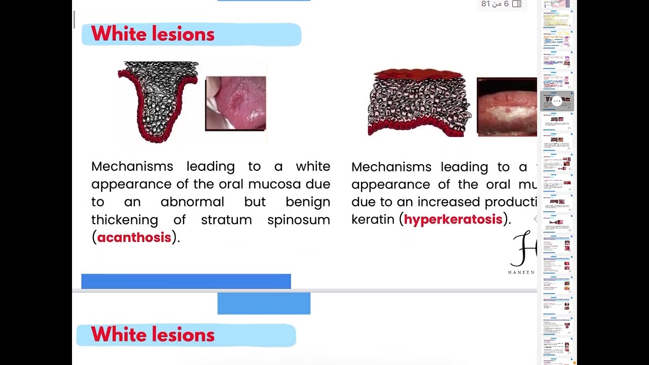 Oral medicine 5th lec 3 Red and white lesion of the oral mucosa ( part 1) 💙