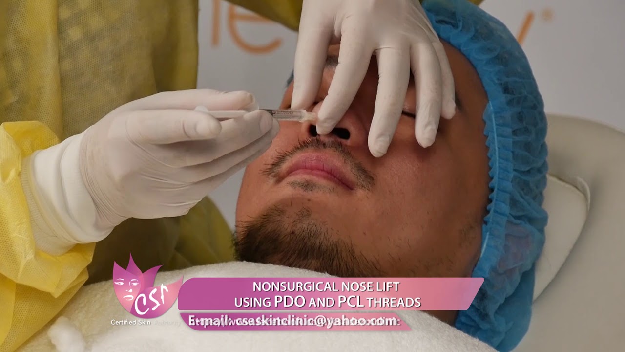 NONSURGICAL NOSE LIFT USING PDO AND PCL THREADS for men
