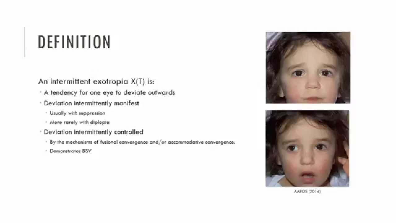 Intermittent Exotropia Characteristics