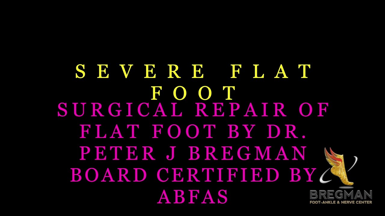 Flat Foot Correction by Dr. Bregman for severe flat foot #flatfeet#Footsurgery#flat  feet