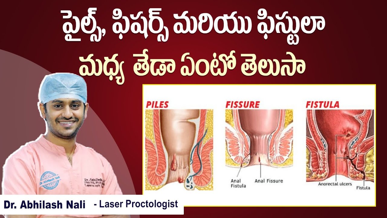 Difference Between Piles, Fissures and Fistula In Telugu || Health Facts || Dr Abhilash Nali