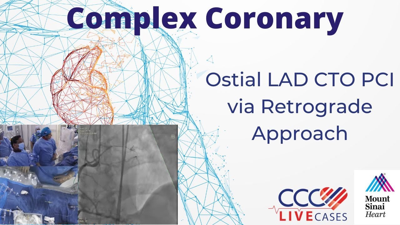 Ostial LAD CTO PCI via Retrograde Approach