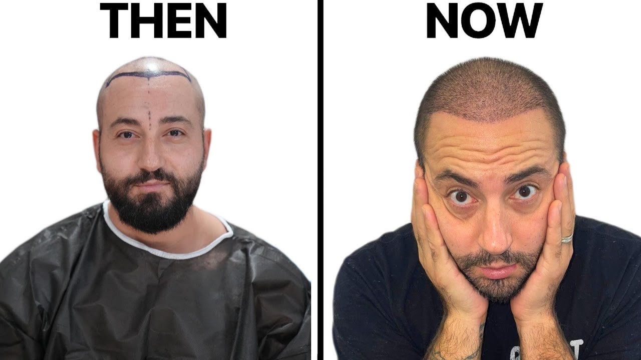 I GOT HAIR TRANSPLANT SURGERY IN TURKEY | BEFORE & AFTER