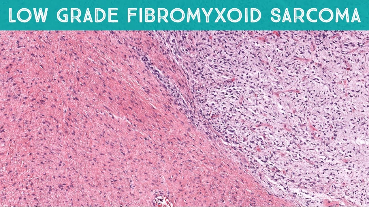 Low grade fibromyxoid sarcoma (Evans Tumor): Cancer that looks SO benign (Oregon Case 9)