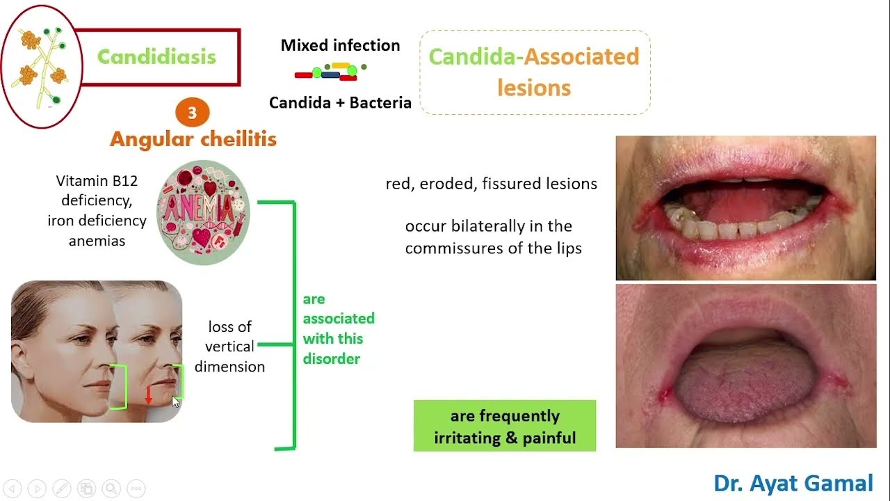 32. Oral  Candidiasis-  Median rhomboid & Angular cheilitis