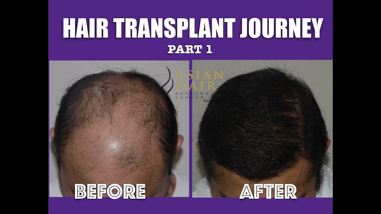 Patient 's Hair Transplant Journey Part 1 -  Asian Hair Restoration Center