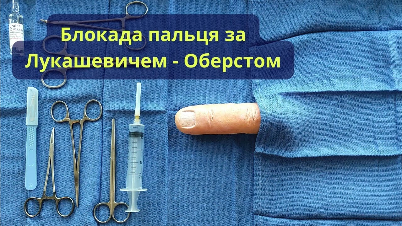 Блокада пальця за Лукашевичем - Оберстом ( Digital block 
