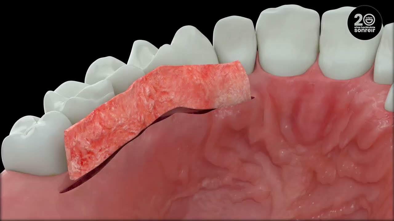 implante Simultaneo Post Extracción SAC - Clínica Dental Patricia Aneiros