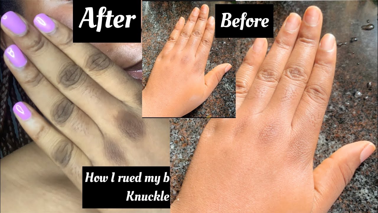 How I ruined my knuckle / and how I was able to clear my dark knuckle