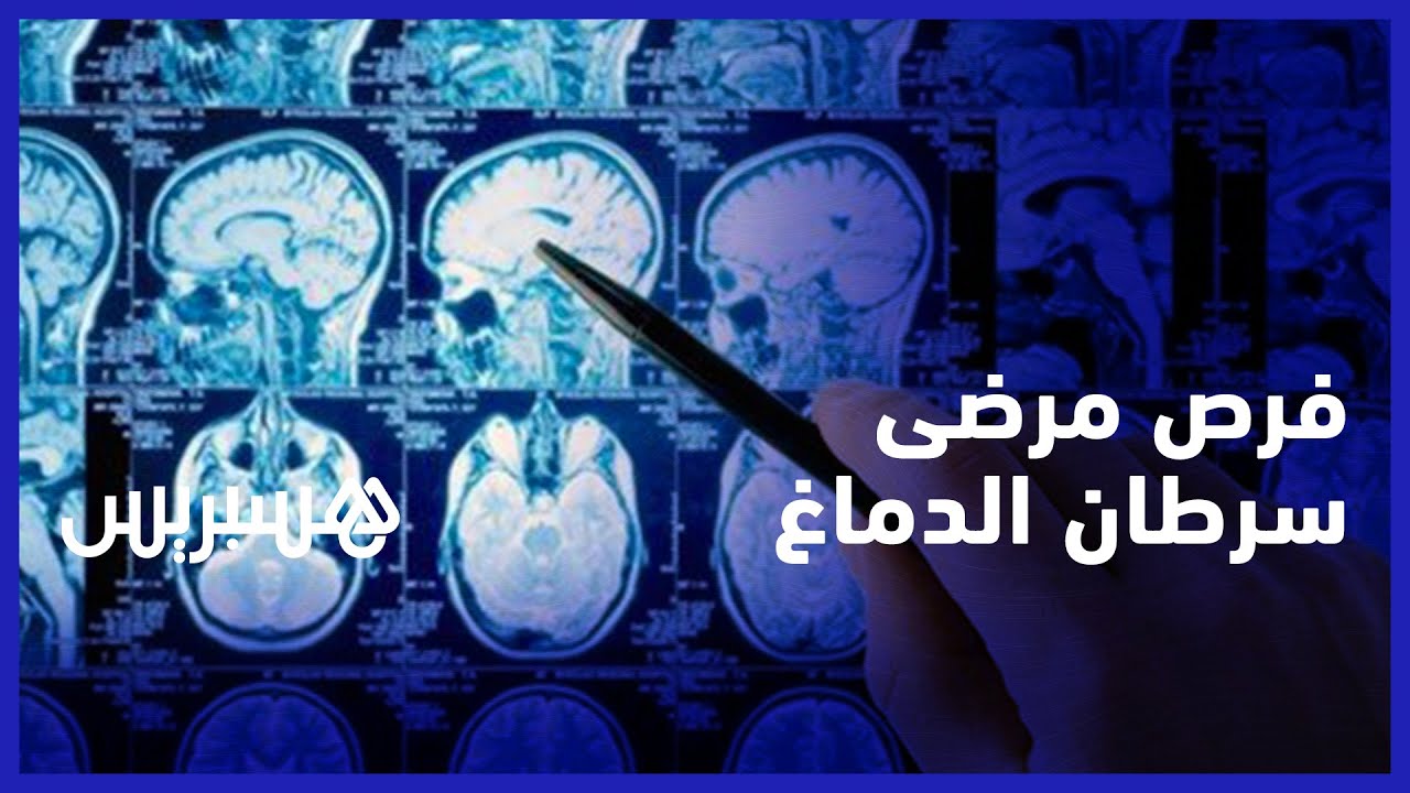 تطور علاج  سرطان الدماغ.. التكنلوجيا توفر علاجات تمنح فرصا لحياة أفضل لمرضى سرطان الدماغ