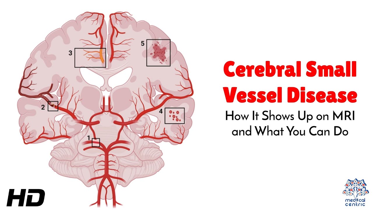 Cerebral Small Vessel Disease : How It Shows Up on MRI and Steps to Protect Your Brain