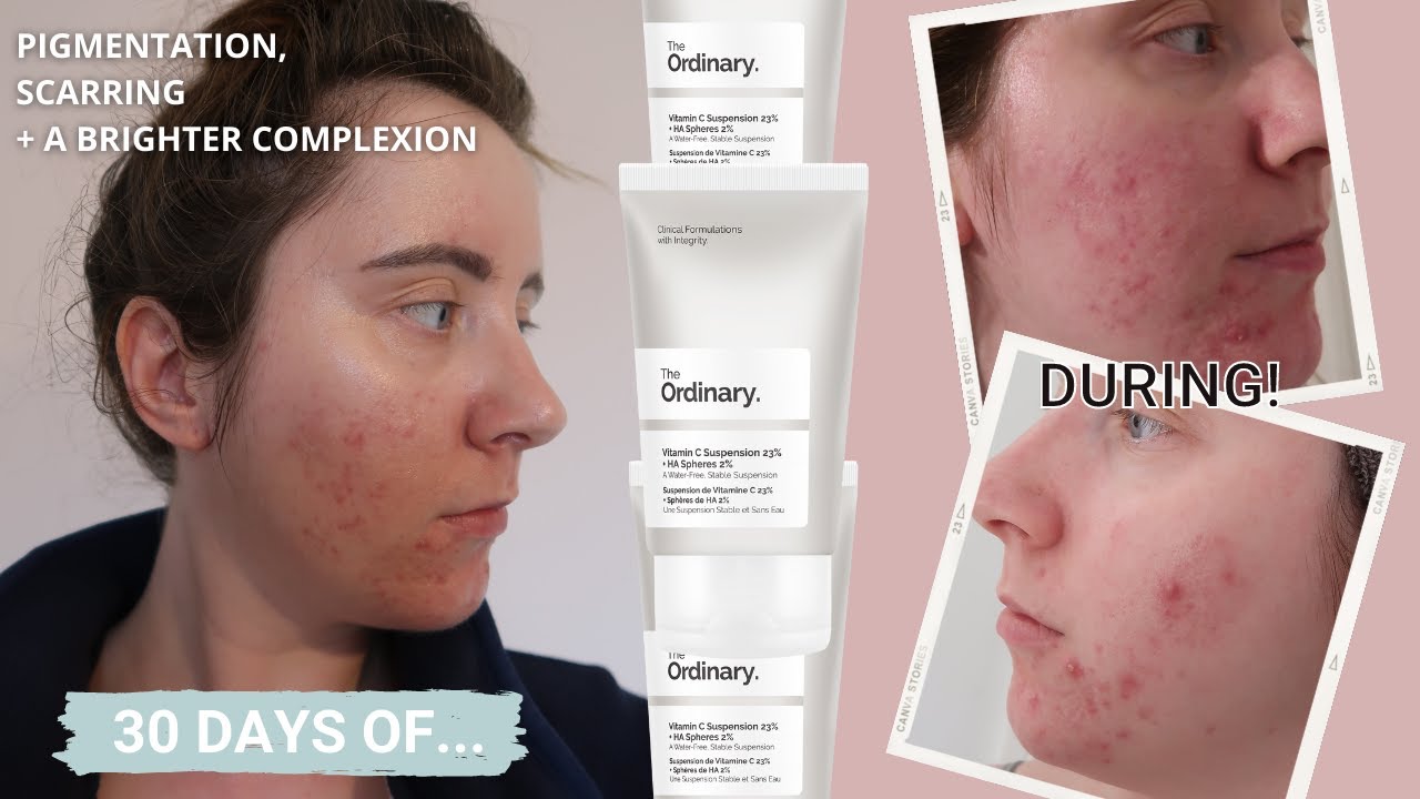 30 DAYS OF...The Ordinary VITAMIN C 23% | One Month review | Pigmentation & Scarring
