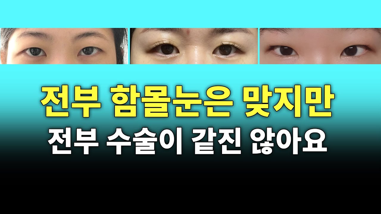 함몰눈의 수술 방법은 정해져있다? 아니요;누가 그래요?;