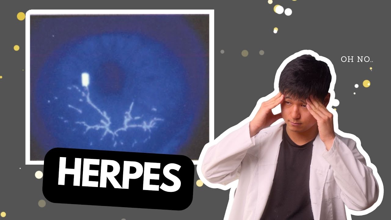 When you get HERPES in the EYE