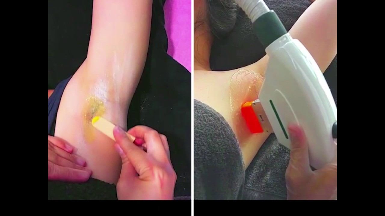 Bubble Gum Wax : IPL vs Waxing