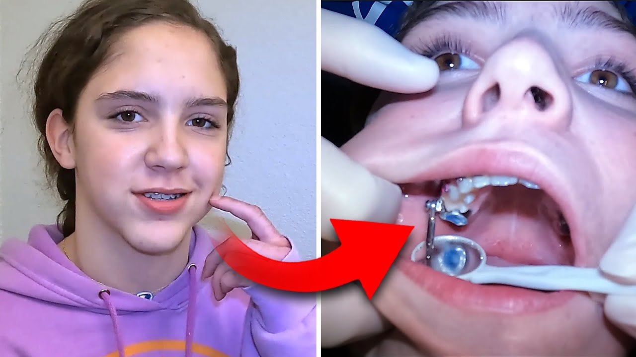 Getting a HERBST APPLIANCE…here’s how it feels | McKinney Orthodontist