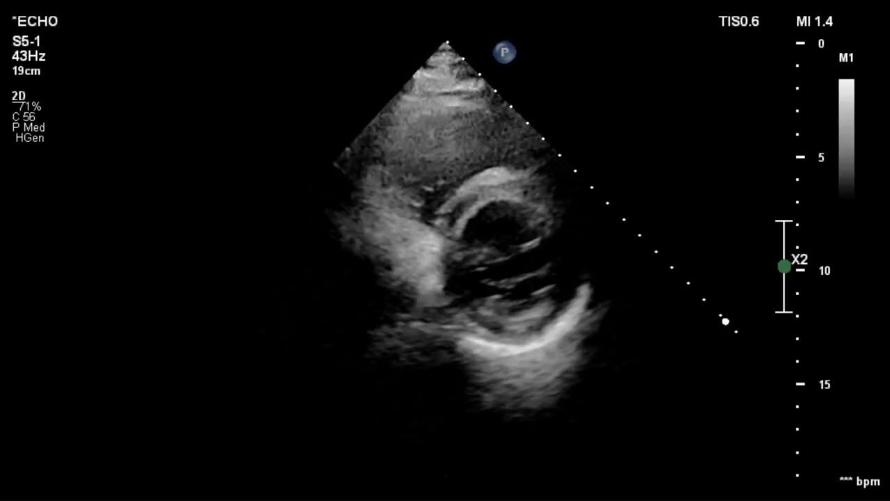 [Echo Case Review] Inferior Wall Motion Abnormality with Severe Diastolic Dysfunction | Echo Case