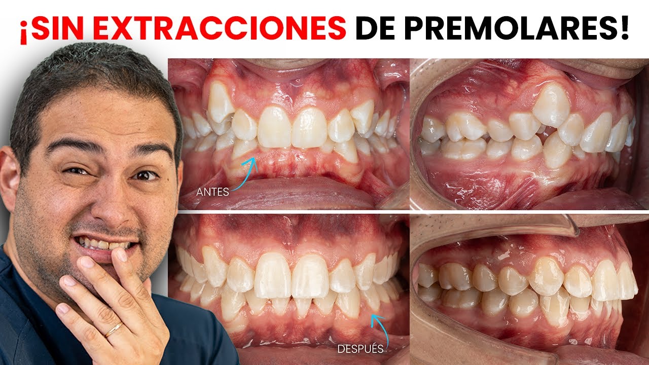 Ortodoncia SIN SACAR LOS PREMOLARES - ¿ES POSIBLE?