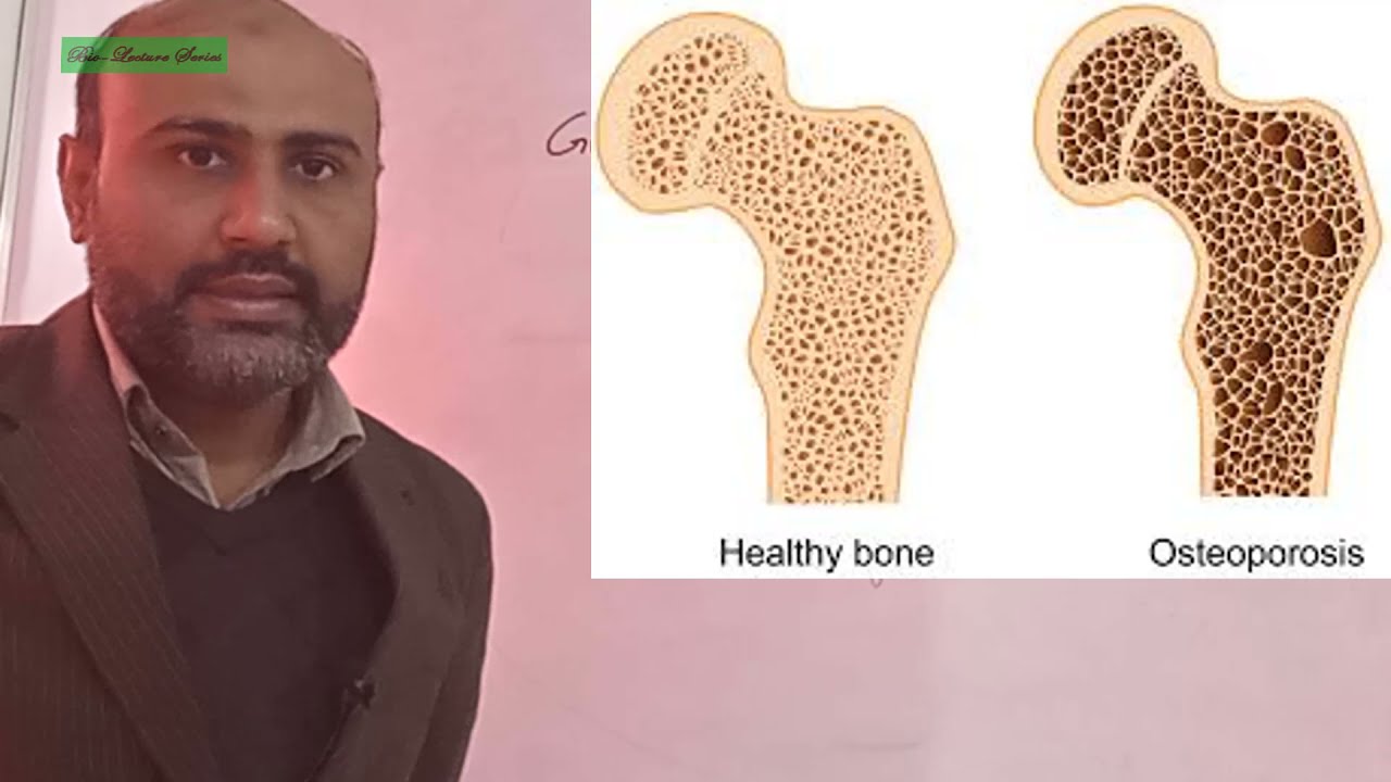 2nd year Biology; Chapter 17; Lecture ; Causes of Deformities in Skeleton
