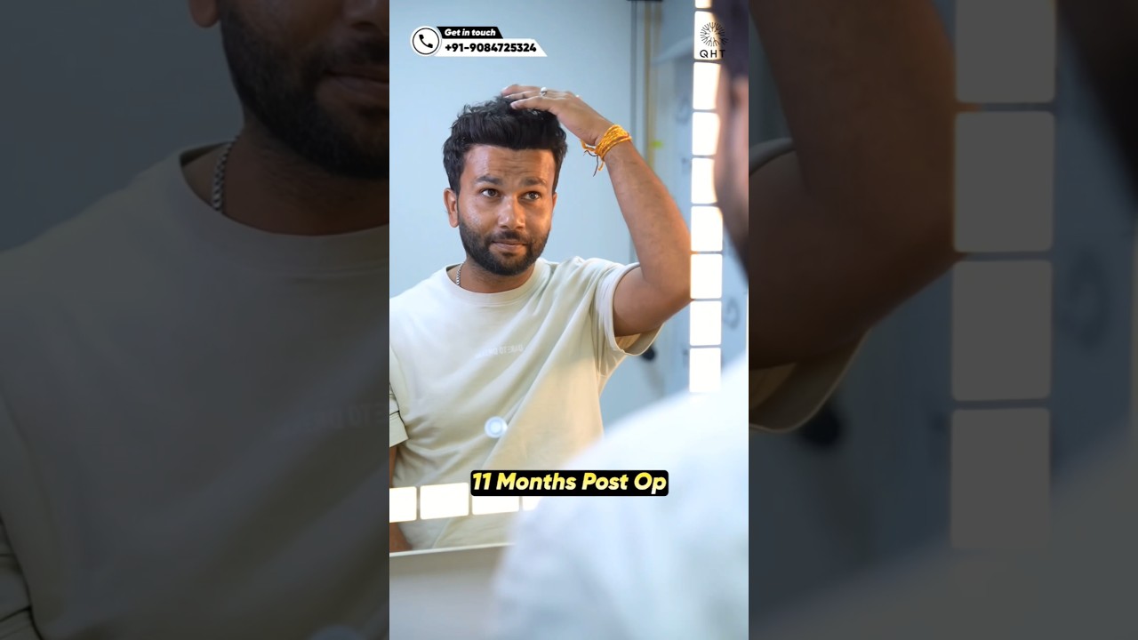 Hair Transplant 11 months result | #qht #hairtransplant #ytshortsindia #shorts #trending #hairloss