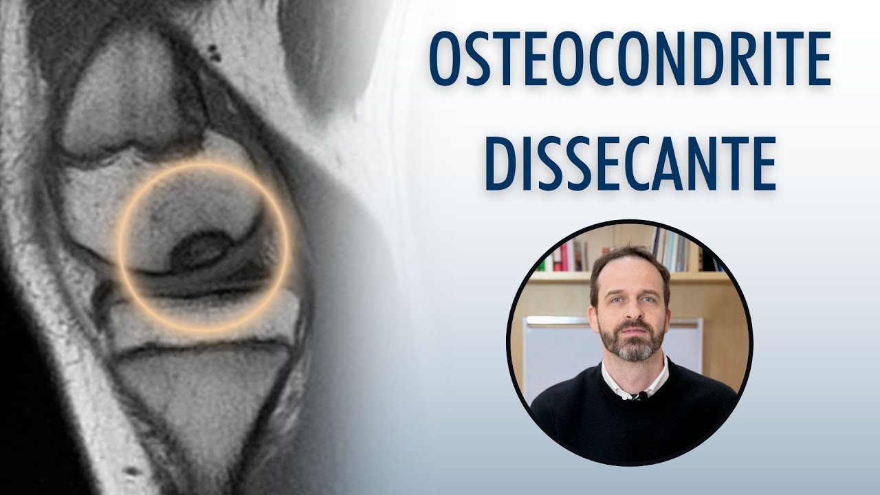 Osteocondrite Dissecante | Entenda esta Lesão que Afeta o Joelho