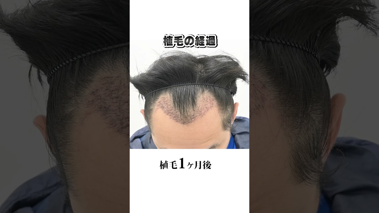 自毛植毛手術の経過記録