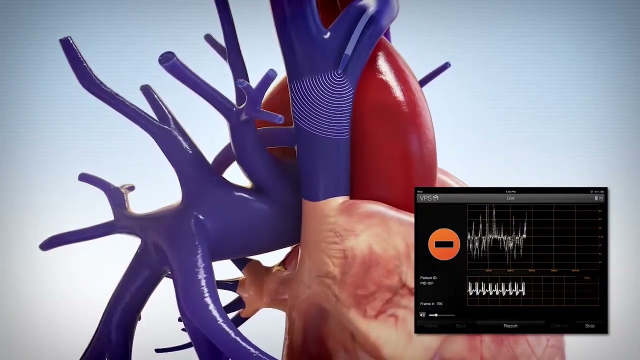 Arrow® VPS G4™ Device Animation