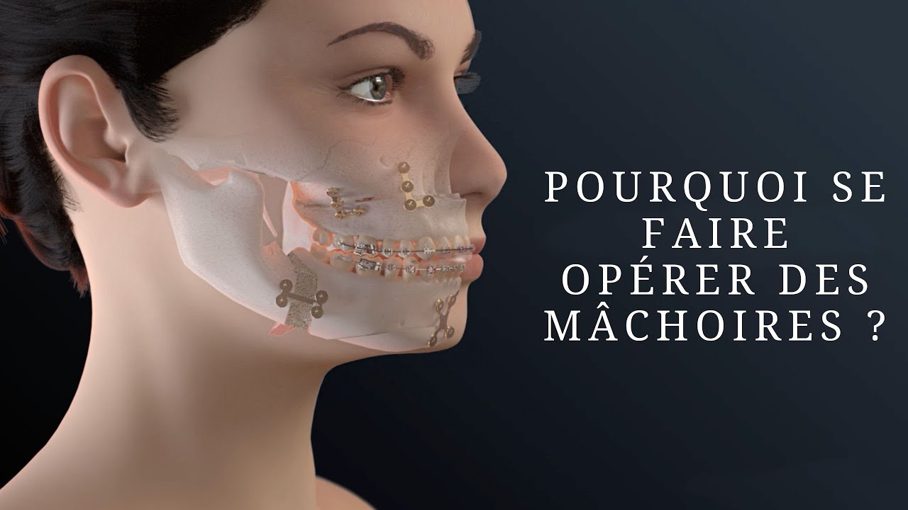 Pourquoi se faire opérer des mâchoires ?