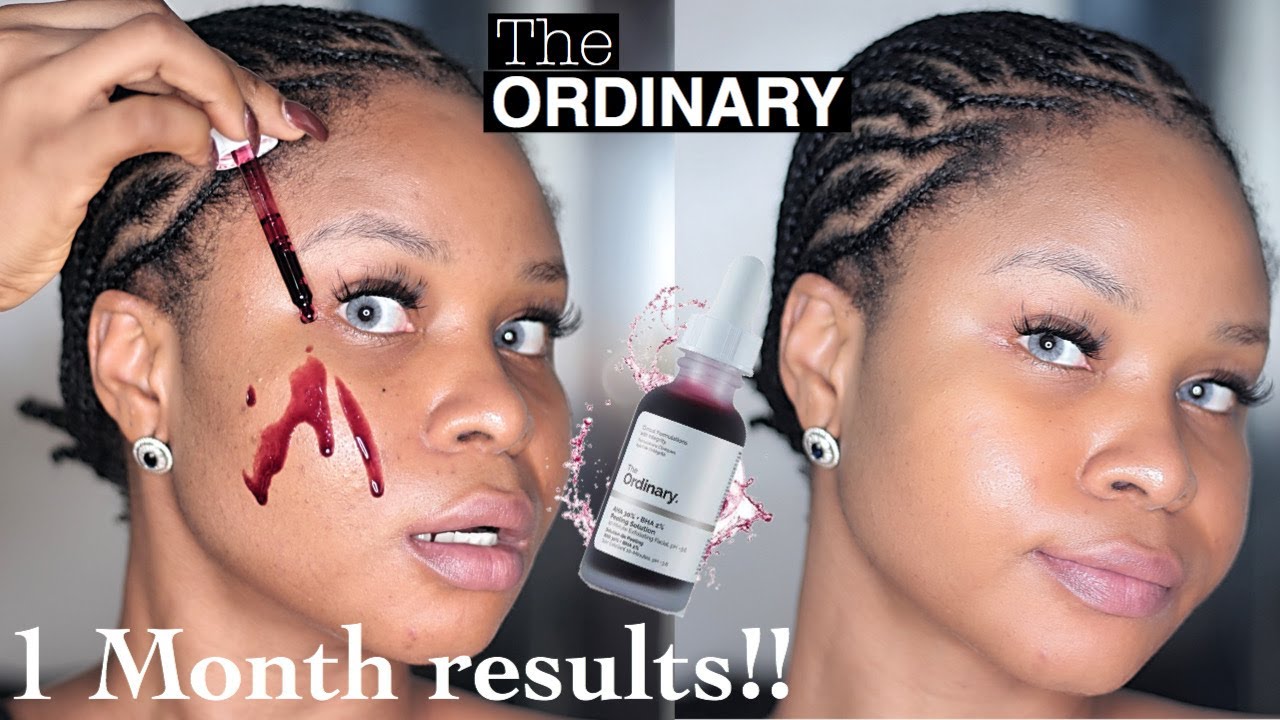 The Ordinary AHA 30% + BHA 2% Peeling Solution || 1 MONTH, REAL results || Honest review