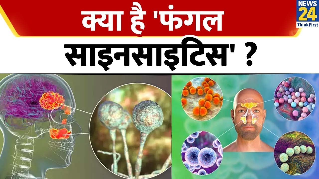 Sanjeevani : क्या है 'फंगल साइनसाइटिस'? Fungal Sinusitis है तो Dr Pratap Chauhan से जानिए JIVA मंत्र