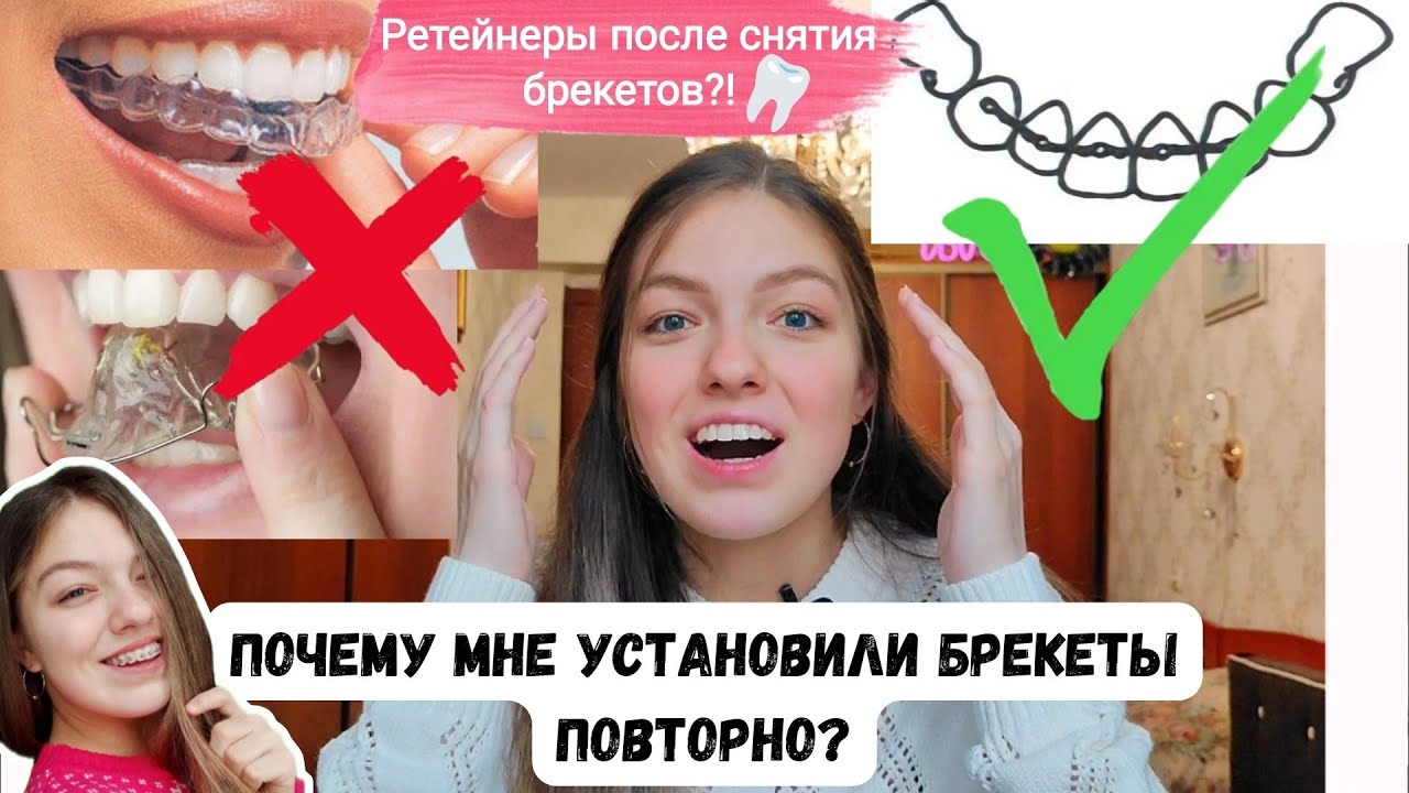Почему мне установили БРЕКЕТЫ повторно?! РЕТЕЙНЕРЫ после снятия БРЕКЕТОВ?! Капы и пластинки