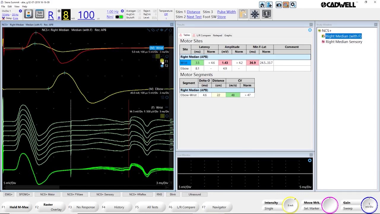 Cadwell Sierra Summit NCS+ Basics Tutorial