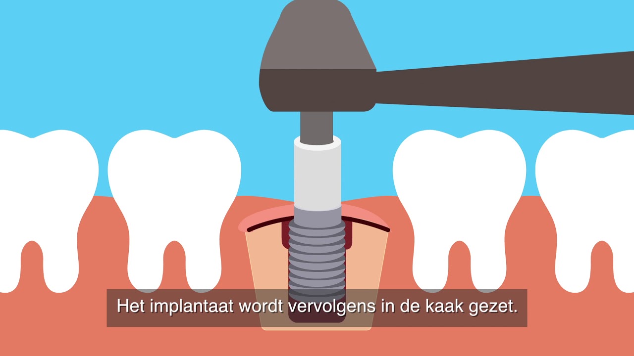 Een implantaat zetten bij de tandarts
