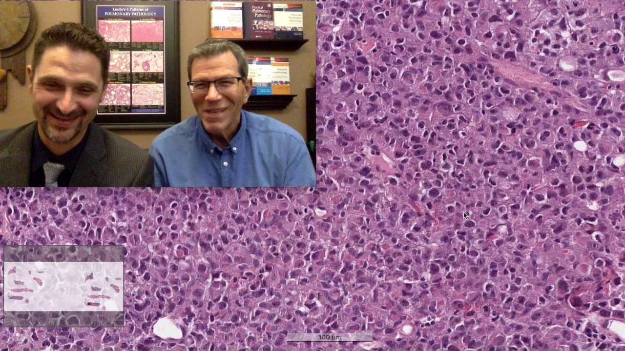 Pattern 5 – Nodules, SMARC A4 Deficient Sarcoma (Top 25 Pearls Series, Topic 5, Pearl 2)