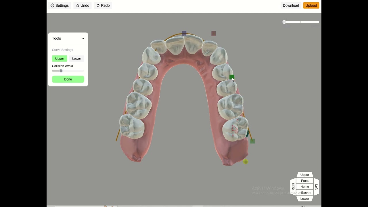 Expansión  ArchForm vs Titan Dental
