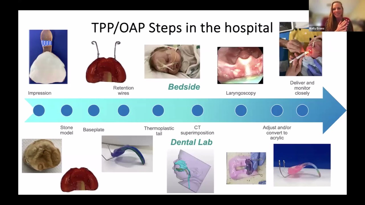 Perspectives on Management of Sleep Disordered Breathing in Infants with Robin Sequence