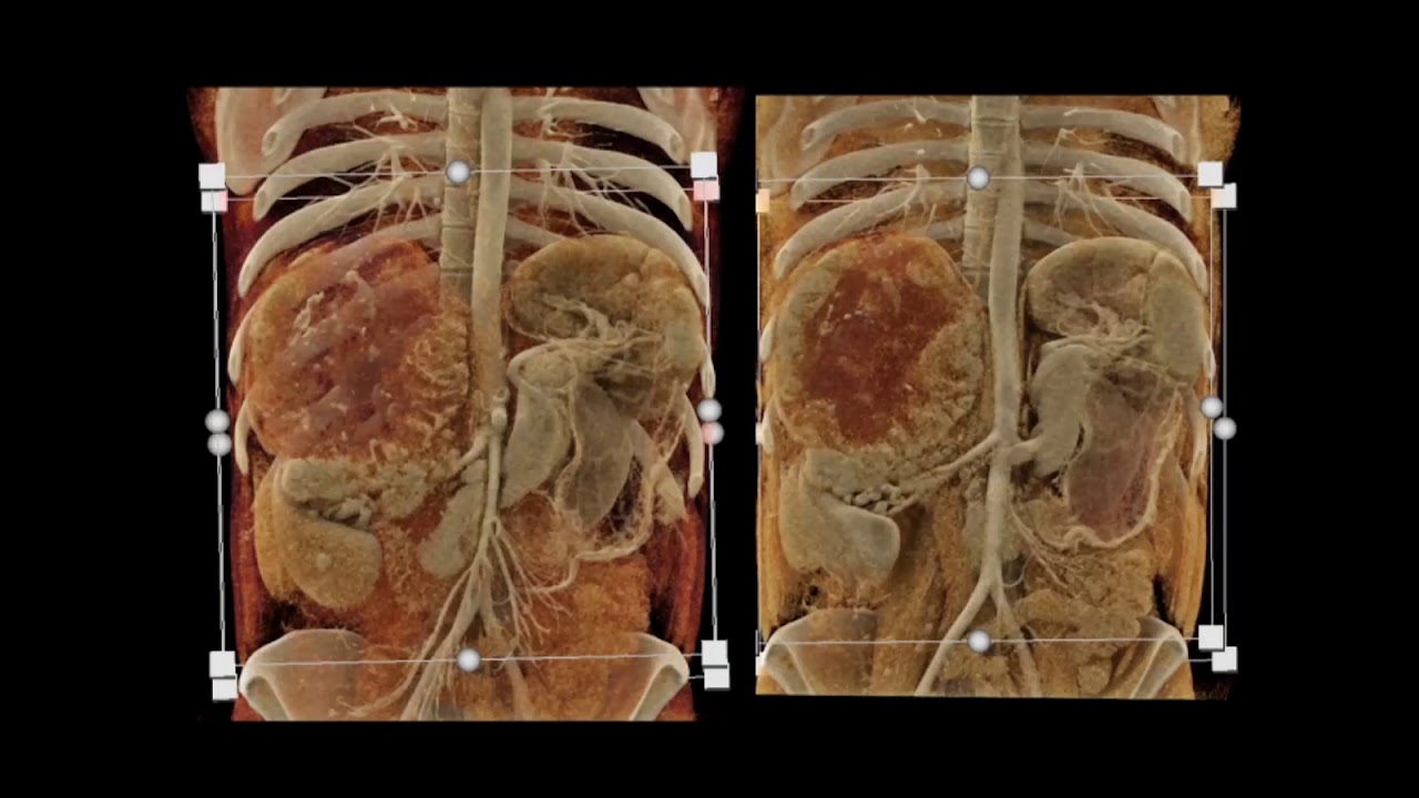 CT of the Adrenal Gland: How to Evaluate an Adrenal Mass Part 2