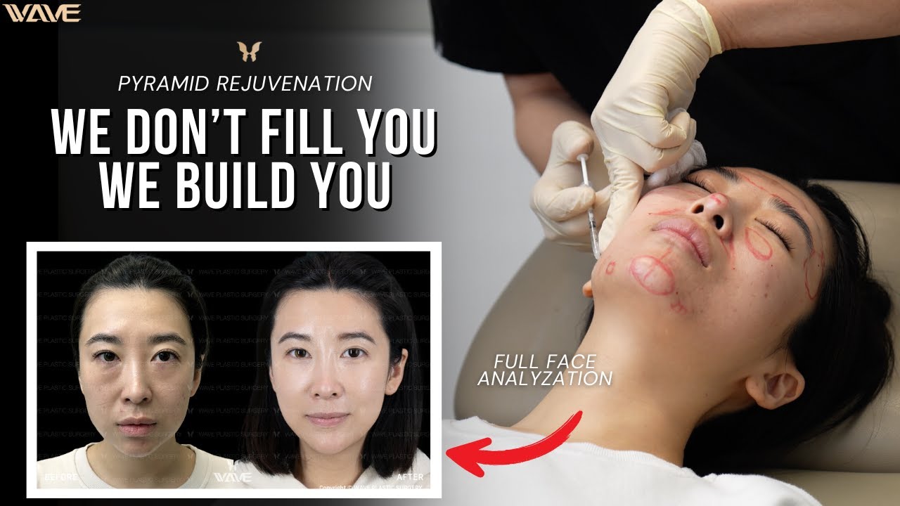 Pyramid Rejuvenation Analyzation: Facial Balancing Using Nothing but Fillers