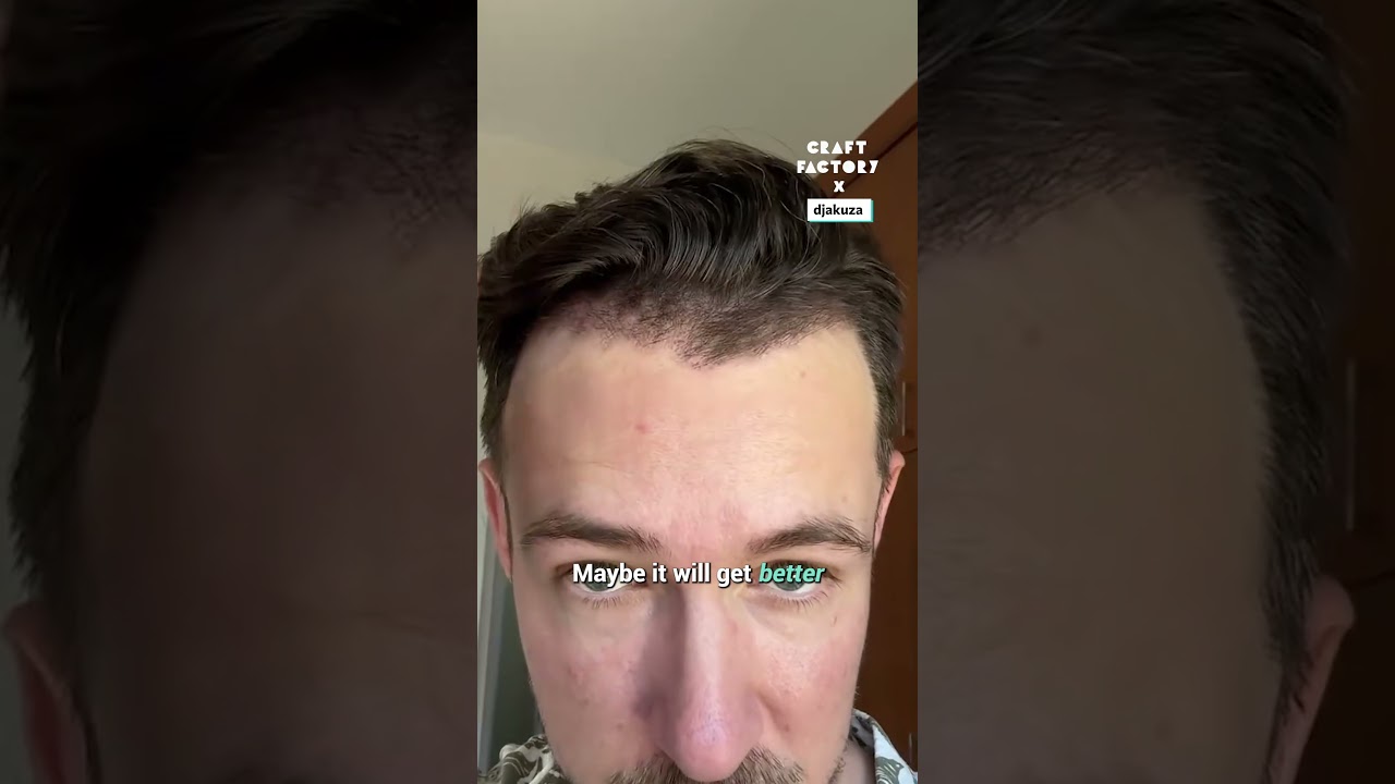I regret my hair transplant 😅