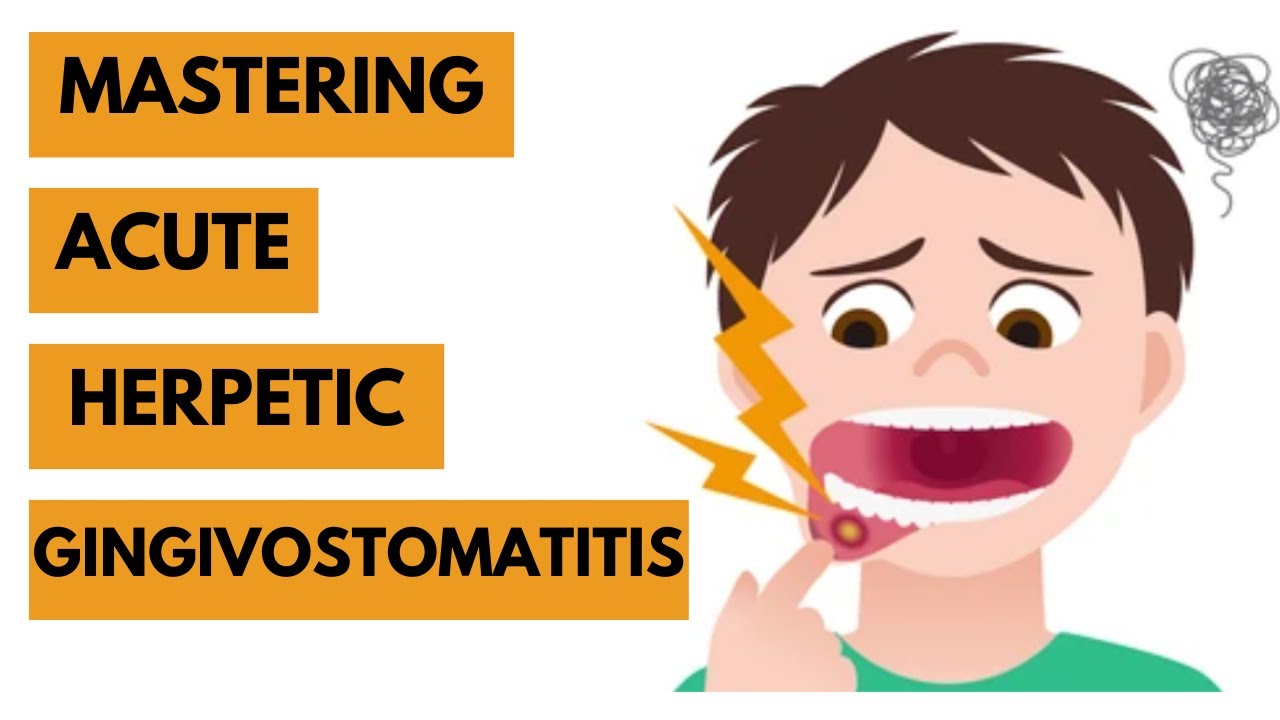 Acute Herpetic Gingivostomatitis -Introduction, Etiology, Clinical Features, & Management