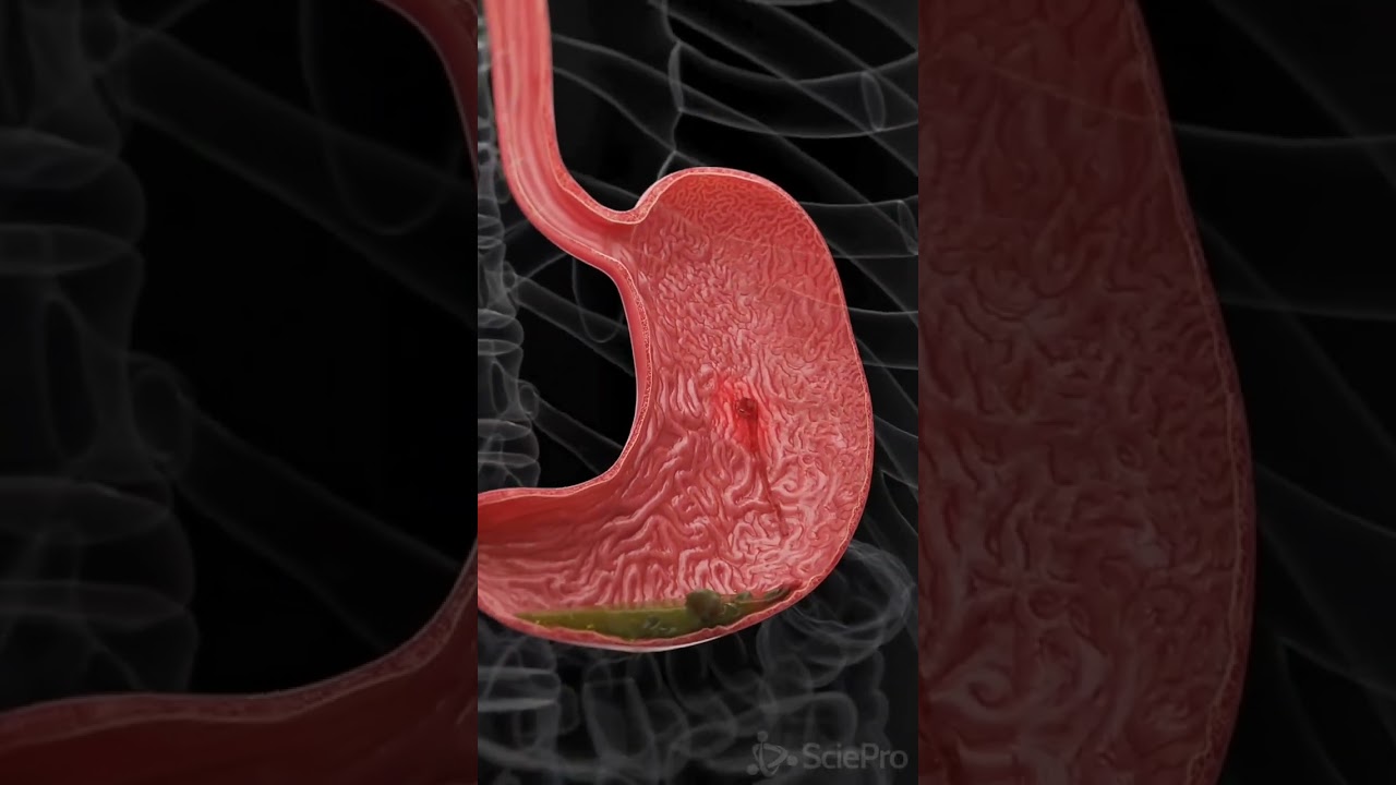 Gastric ulcers cause internal bleeding #anatomy#pathology#shorts