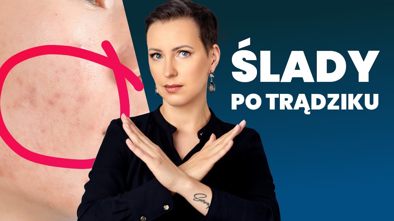 Blizny i przebarwienia po trądziku - jak się ich pozbyć?