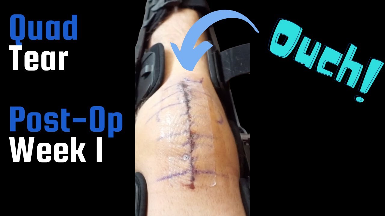 Quadriceps Tendon Tear -Post-Op Week 1 - Part 3