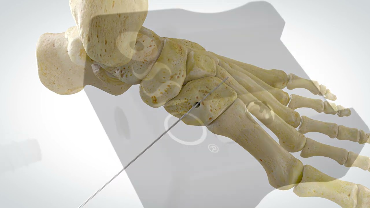 OSSIOfiber® Threaded Trimmable Fixation Nail - Lisfranc Technique